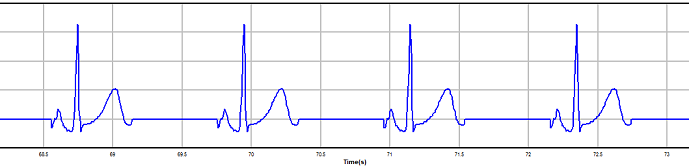 SinusBradycardia_BioGears.PNG