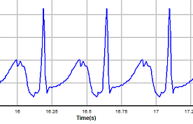 SinusTachycardia_BioGears.PNG