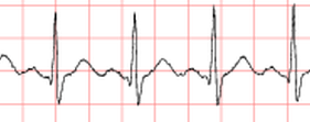 SinusTachycardia_Physionet.png